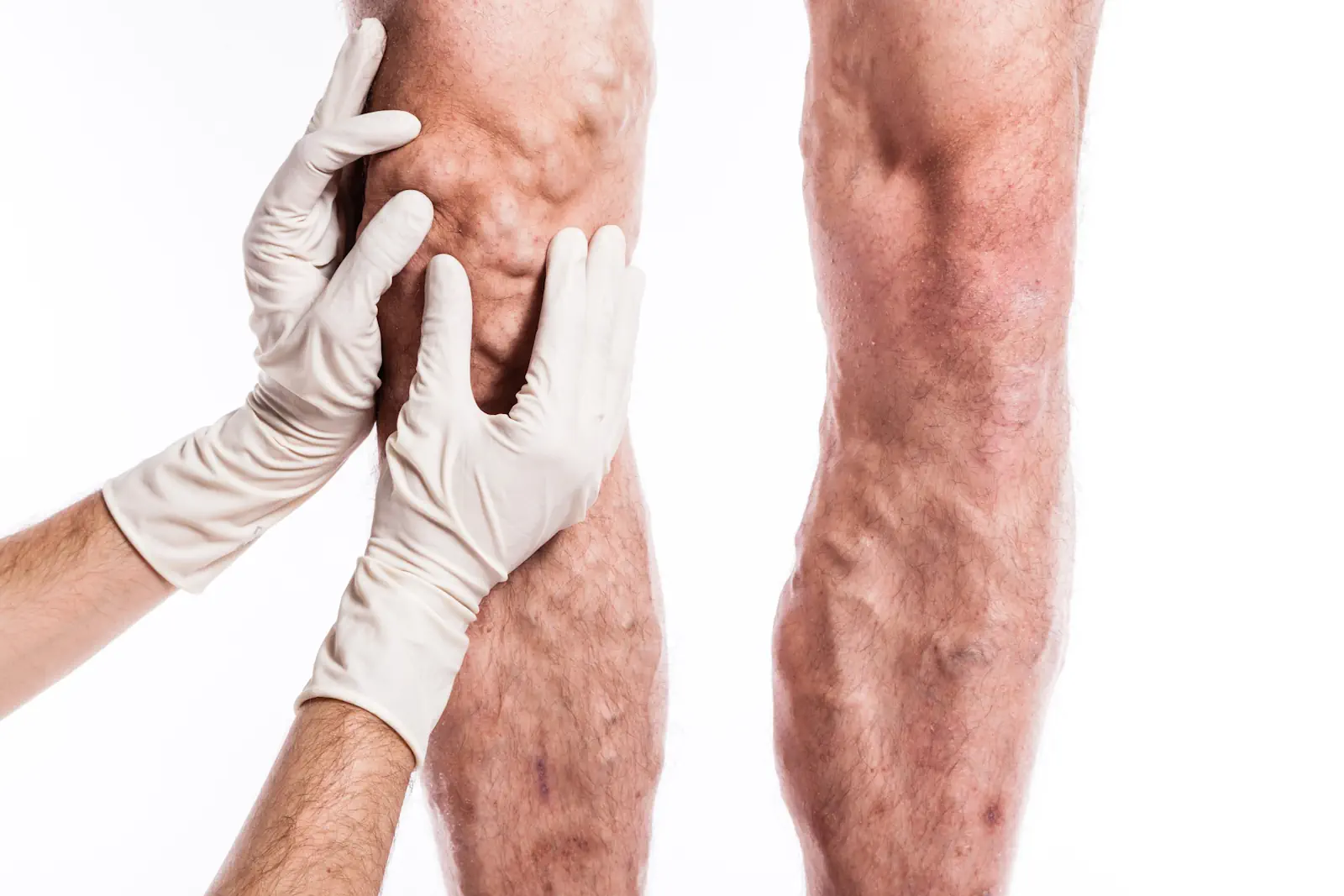 Medical examination of varicose veins and vascular disease in legs - Hamilton NJ vein specialist