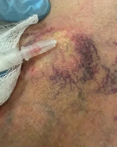 During vein treatment procedure